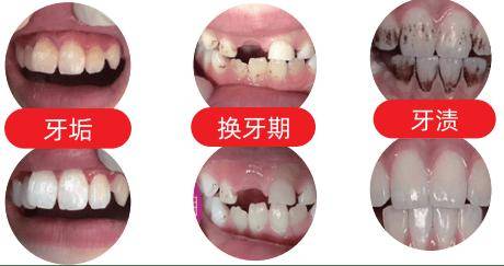 【章小蕙推荐】牙黄怎么办？瑞士怀尔德牙膏告诉你安全不伤牙的白牙方法